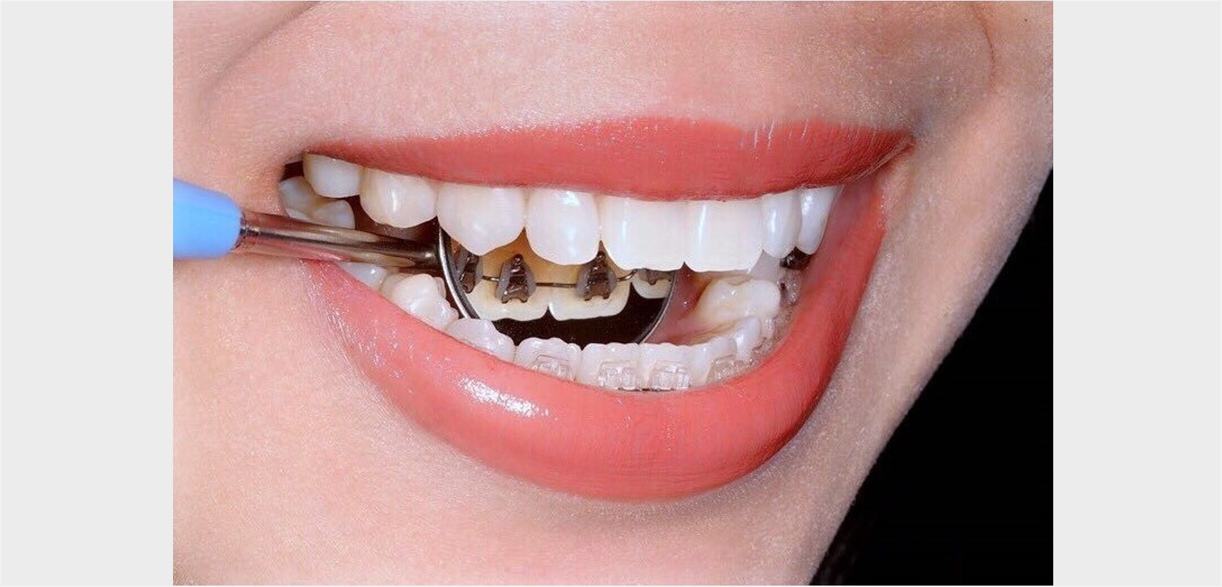 Lingual Braces & Combination - Mount Elizabeth Orthodontic Clinic